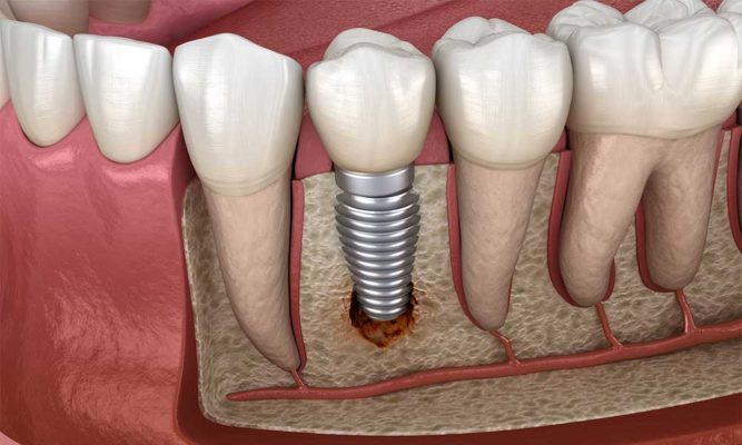 Dental-implants-in-thane